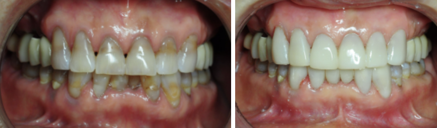 No-Prep Laminates for Teeth: If Done Incorrectly, They Can Make Front Teeth Protrusion Worse image 7