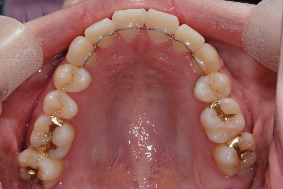 Orthodontic Retainer Period: A Clear Guide image 2