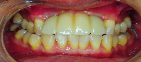 앞니임플란트치과 찾기 전 제발 이 글부터 읽어보세요 관련 이미지 2