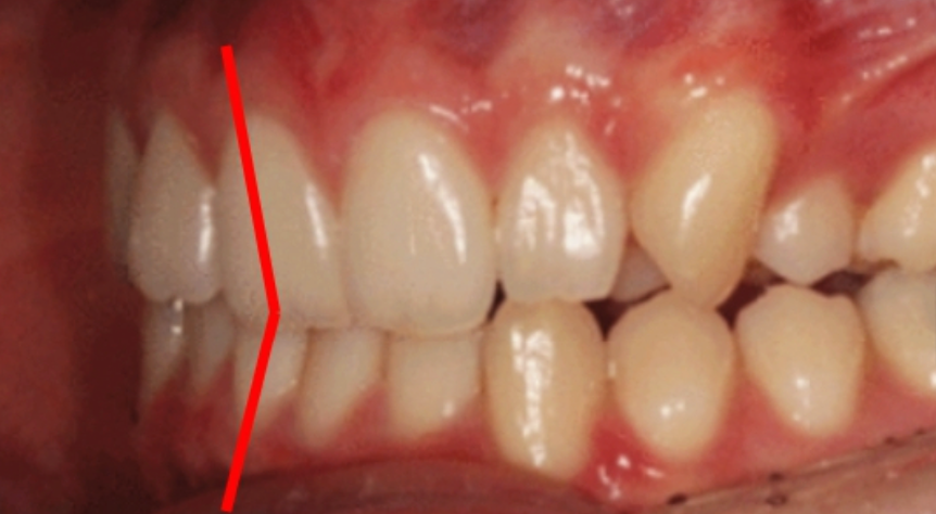 What Is the Key to Correcting Deep Bite and Inward-Tipped Teeth? Must Read to Avoid Retreatment image 8