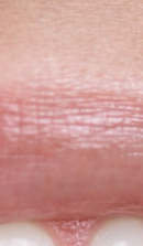 What should you be sure to check before deciding on Gangnam laminate dentistry? image 29