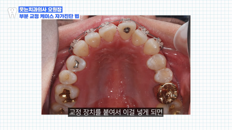 부분교정하고 이렇게 변했습니다 교정 전후 비교 관련 이미지 4