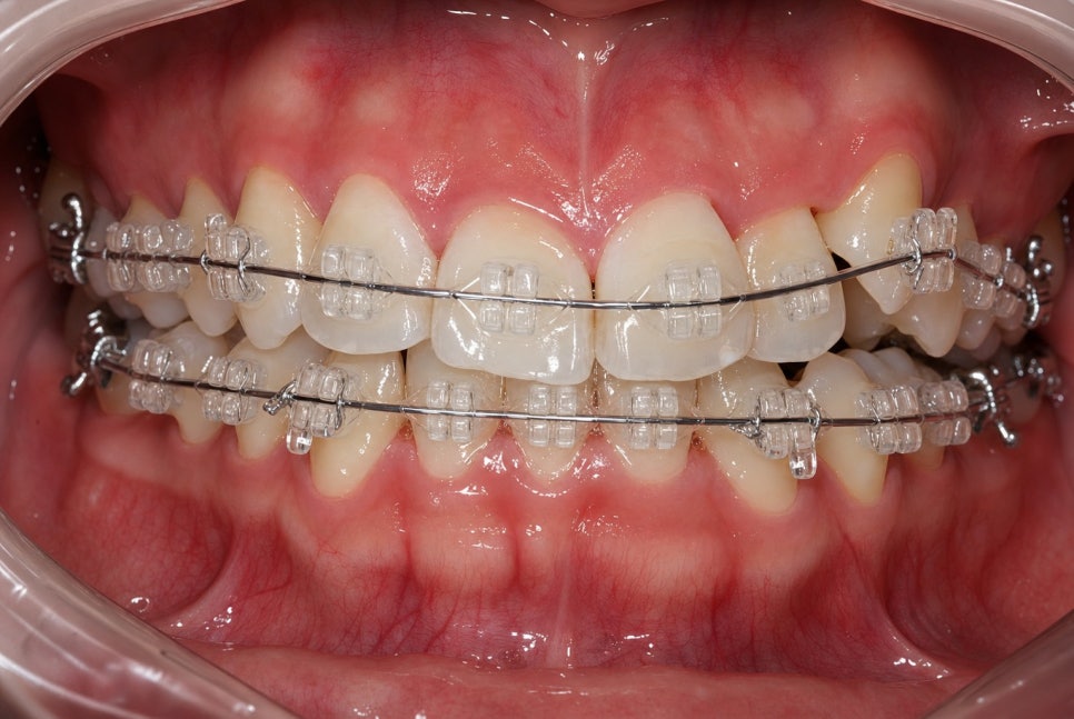 Orthodontic Treatment for Crooked Teeth: Insights from a Dental Clinic near Gangnam Sinsa Station image 15