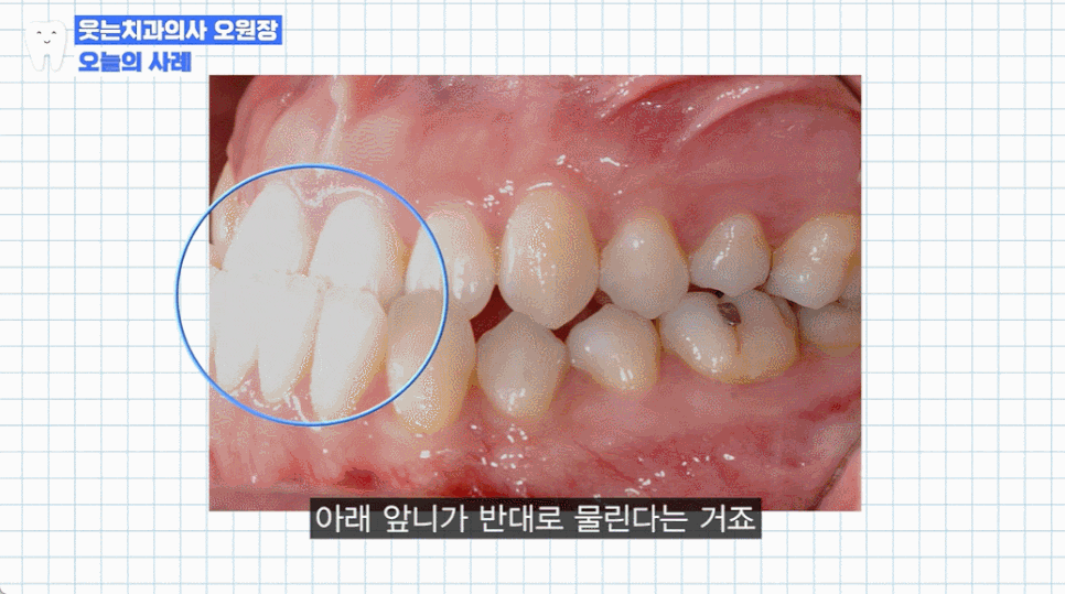 주걱턱 치아교정? 효과적인 주걱턱 교정 시기는 언제 관련 이미지 7