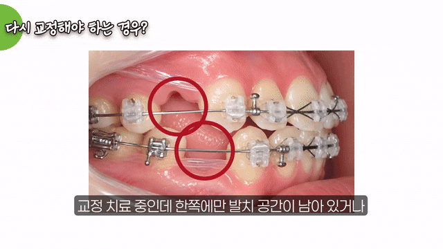 치아교정 고무줄, 하루 몇 시간 착용해야 할까요? 관련 이미지 8