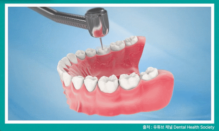 나비 앞니 교정 관련 이미지 5