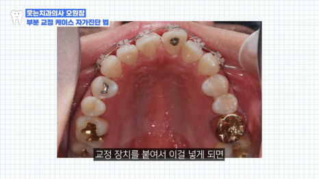 치아교정 앞니부분교정 가능할까? <전문의 답변> 관련 이미지 6