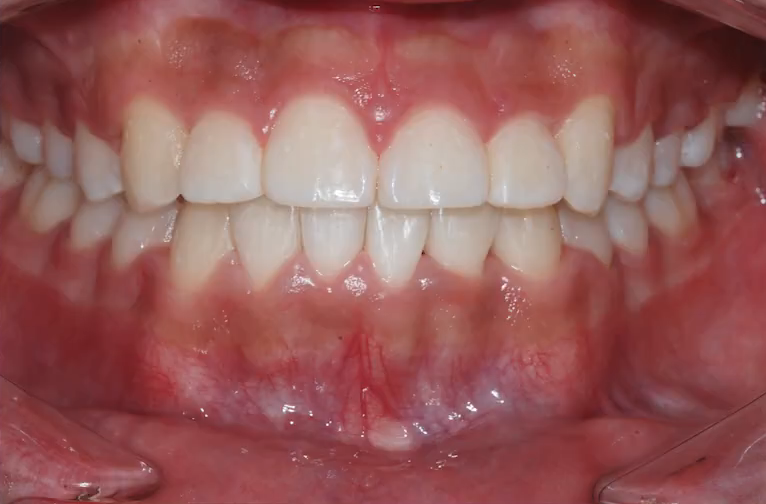 악궁확장 장치로 발치 피한 교정 사례, 나도 가능할까? 관련 이미지 9