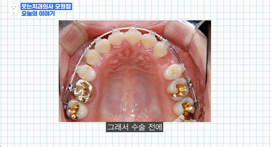 주걱턱 교정 VS 양악수술? 교정과 전문의가 답변드립니다 관련 이미지 21