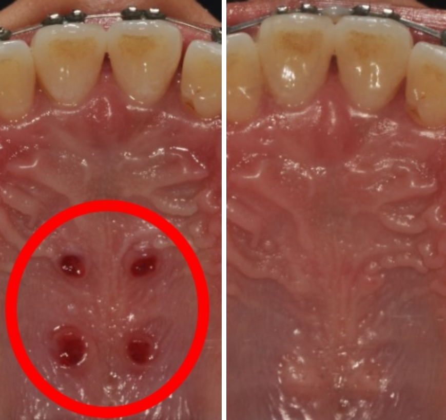 Why Are Invisalign Screws Placed, and How Much Do They Hurt? image 8