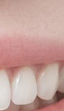 서울라미네이트치과 알아보고 있다면 관련 이미지 30