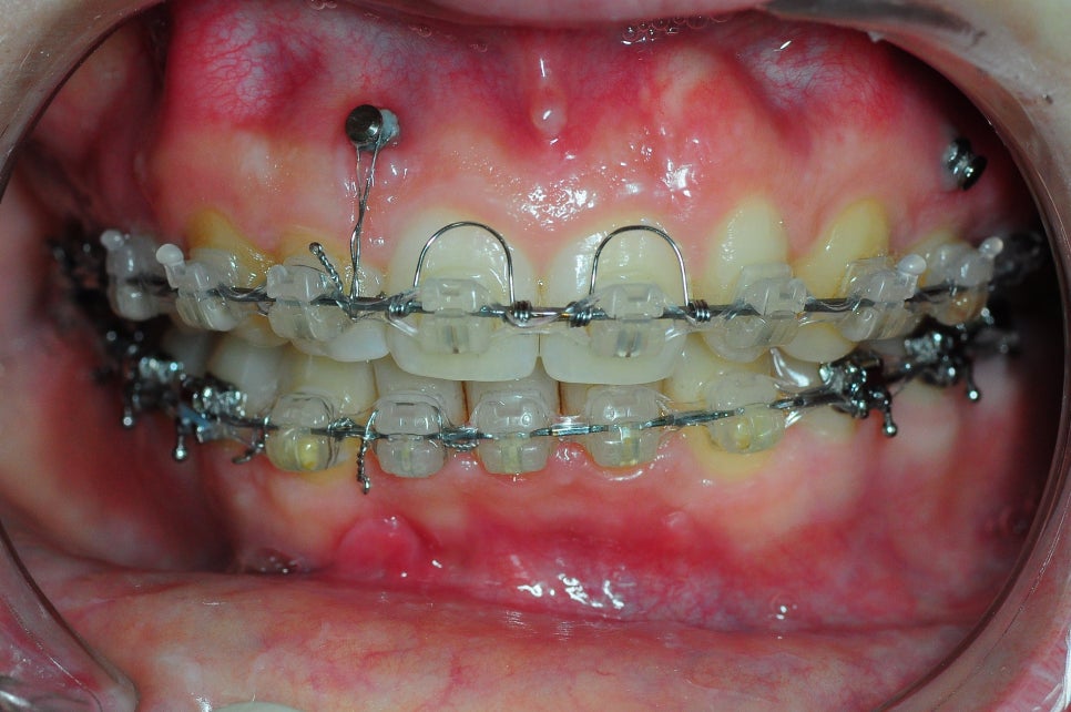 What Is the Key to Correcting Deep Bite and Inward-Tipped Teeth? Must Read to Avoid Retreatment image 12