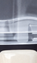 40대 치아 교정 고민 중이라면? 부담 줄이고 효율 높이는 선택법 관련 이미지 39