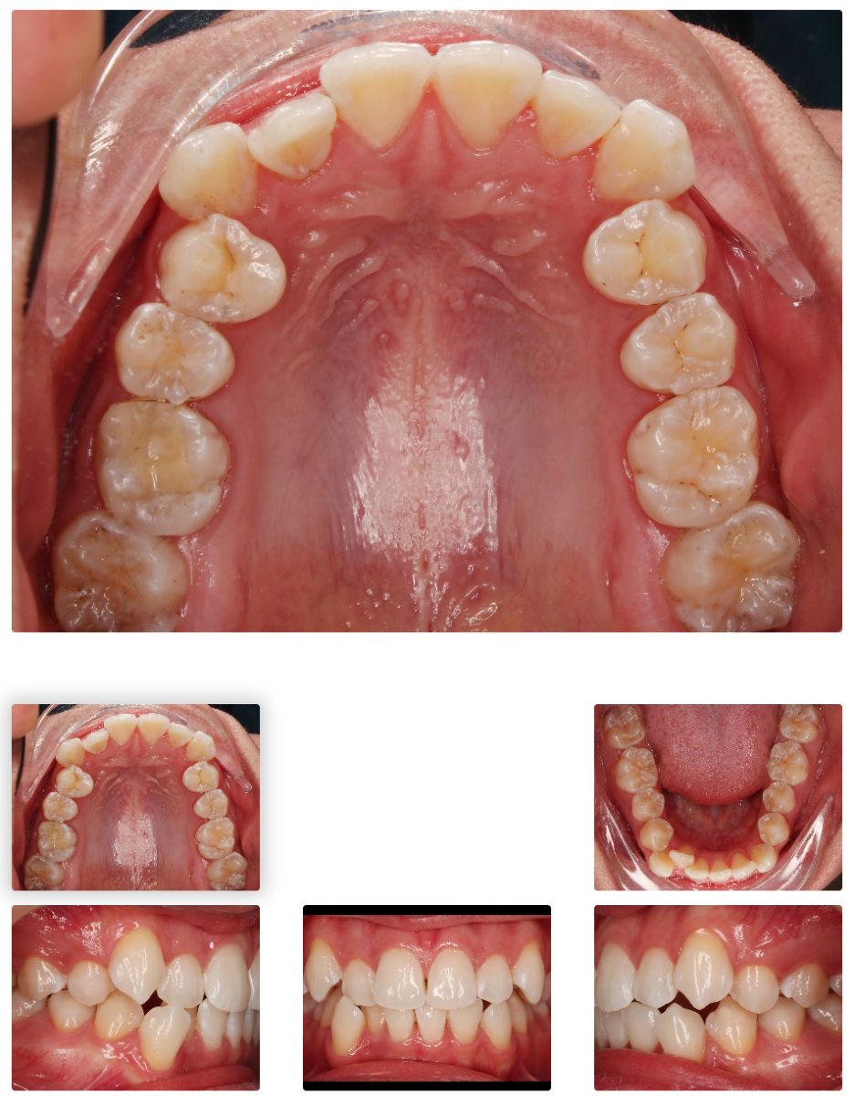 Gap Between the Front Teeth? Don’t Judge It by Front Teeth Partial Orthodontic Reviews Alone image 7