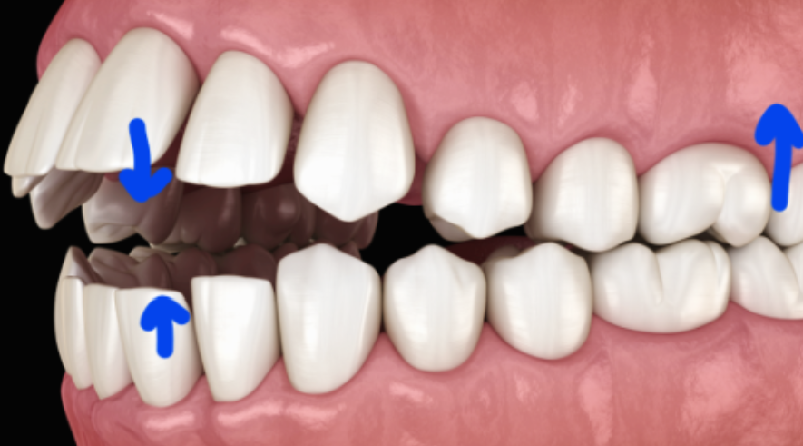 투명 교정 가격과 개방교합 인비절라인 장점에 대해 관련 이미지 4