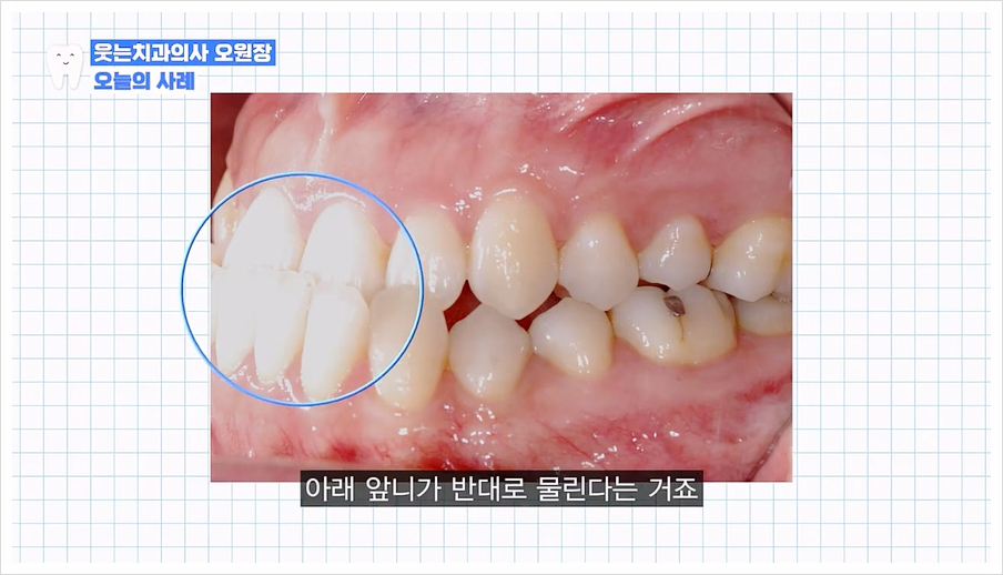 주걱턱 교정 VS 양악수술? 교정과 전문의가 답변드립니다 관련 이미지 8