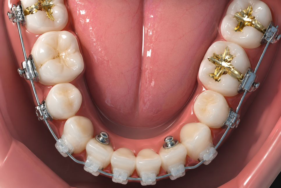 When Tooth Extraction Is Necessary for Protruding Mouth Correction image 6