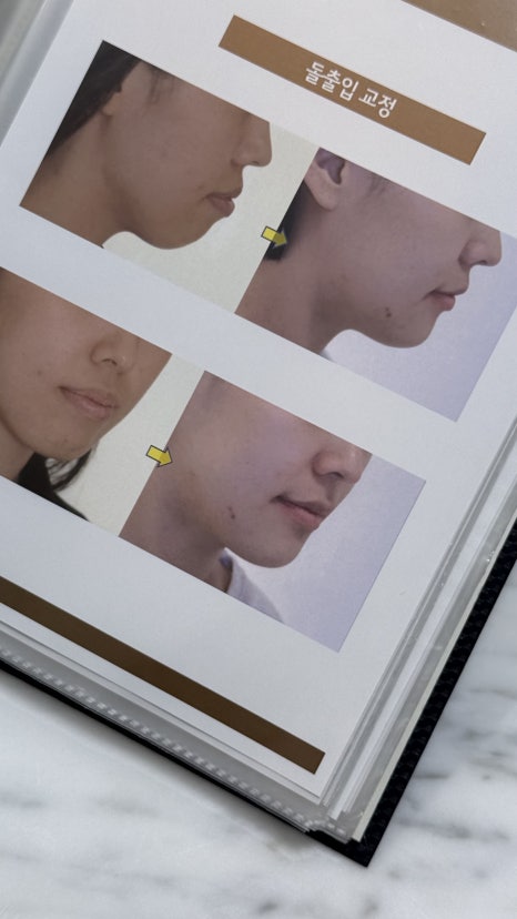 인비절라인 교정으로 몰래 예뻐지기, 스마일디치과 18년 노하우 관련 이미지 7