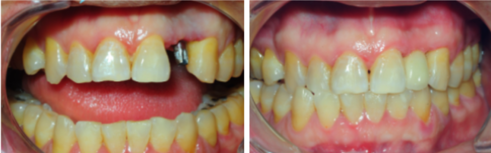 Who Can Get an Implant on the Day of Surgery? (Cases Where Immediate Placement Is Possible After Tooth Extraction for Implants) image 5