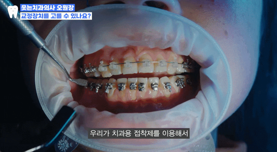 Why Do You Need to Wear Orthodontic Rubber Bands? Explaining Along with the Principle of Orthodontic Brackets image 4