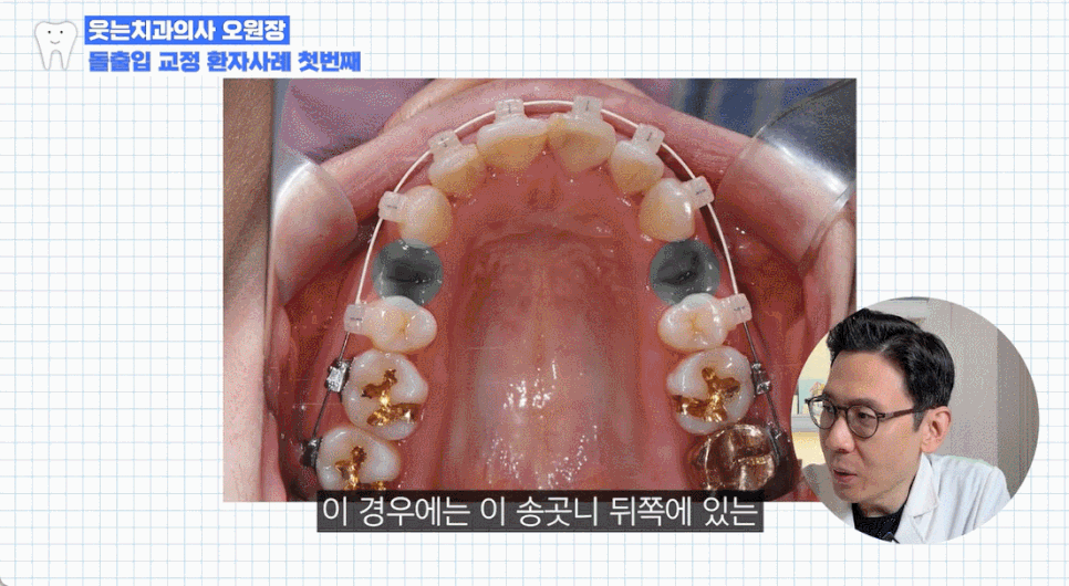 Non-extraction orthodontics? If you have this kind of protruding mouth, orthodontic treatment will not be effective image 15