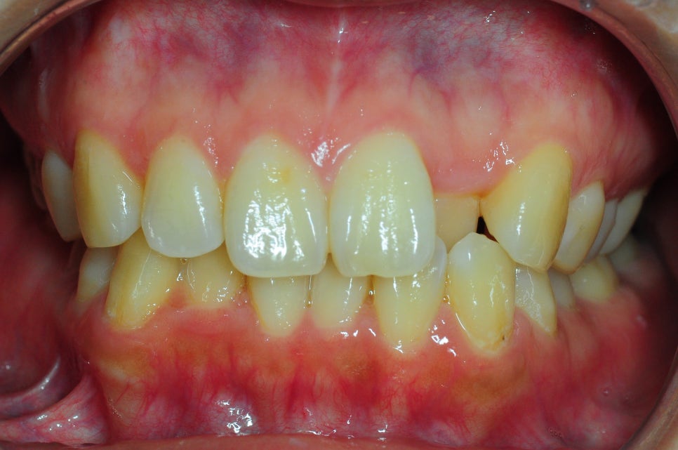 Does Invisalign Really Not Hurt? Do You Have to Have Teeth Extracted? image 6