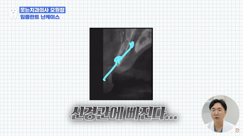 Looking Into Full Implant Placement Methods and Precautions image 9
