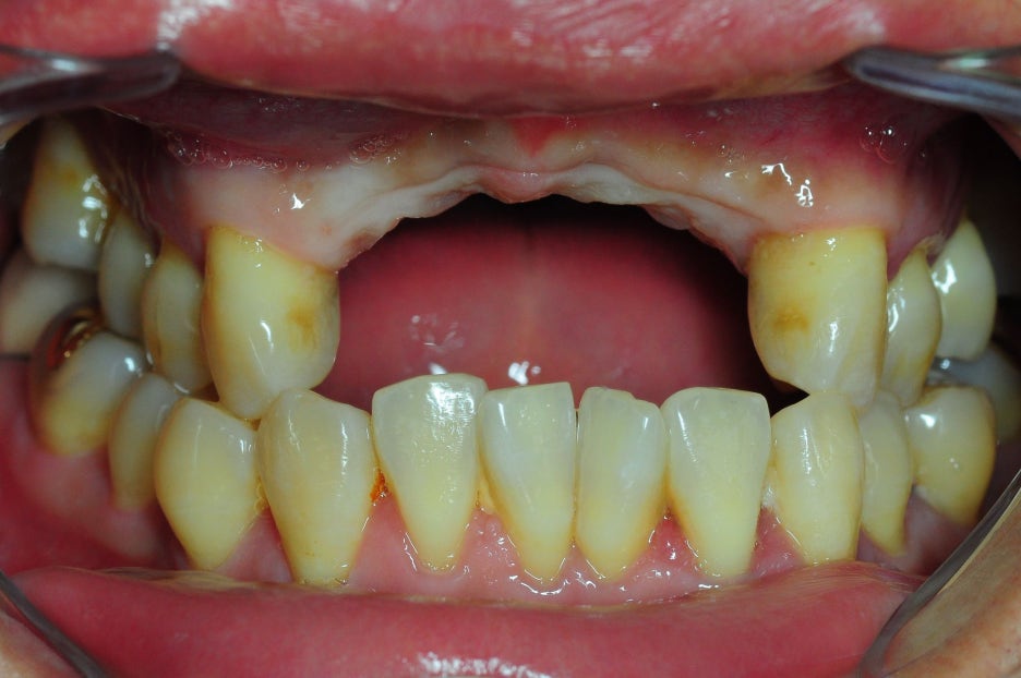 Is Same-Day Implant Possible? What You Must Know Before Implant Surgery image 2