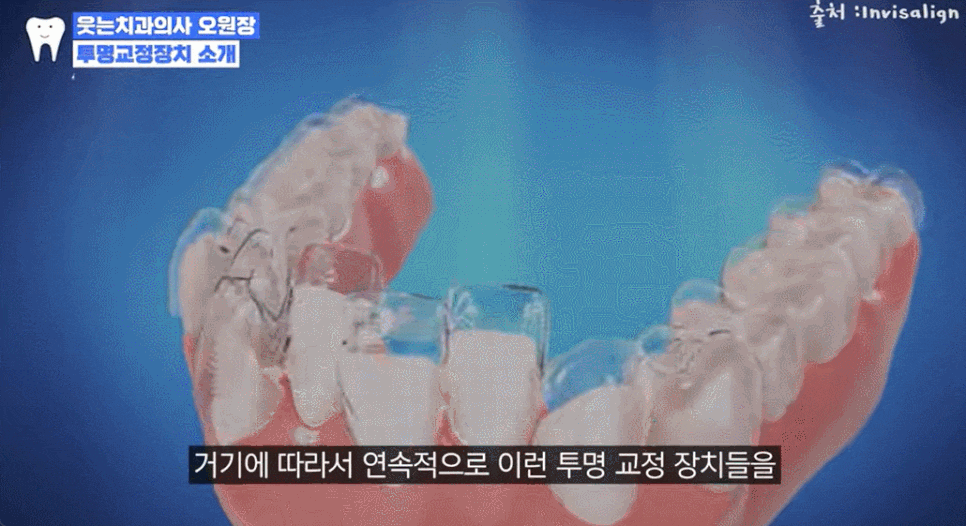 투명교정가격? 강남투명교정 가격대는 관련 이미지 3