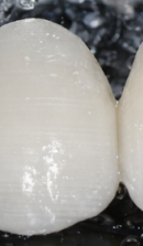 신사역 라미네이트 치과, 자연스러운 미소를 결정짓는 비밀 관련 이미지 36