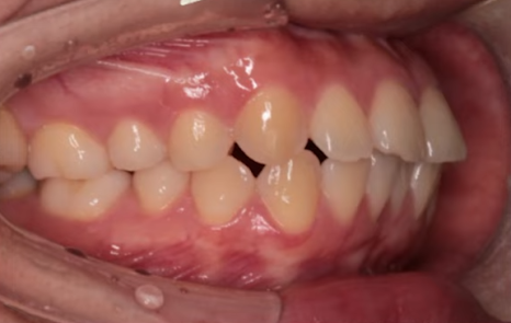 돌출입수술 대신, 인비절라인 돌출입 개선 사례 관련 이미지 10