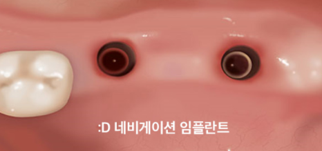 Can Non-Incisional Implants Reduce the Implant Treatment Period? <Doctor's Answer> image 11