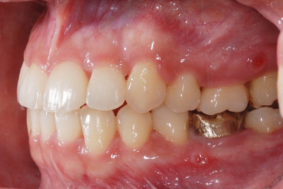 Gap Between the Front Teeth? Don’t Judge It by Front Teeth Partial Orthodontic Reviews Alone image 4