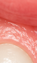 What to Check When Considering No-Prep Laminate Veneers in Gangnam image 32