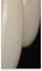 앞니 벌어짐 치료 전 반드시 체크해야 할 것들 정리 관련 이미지 34