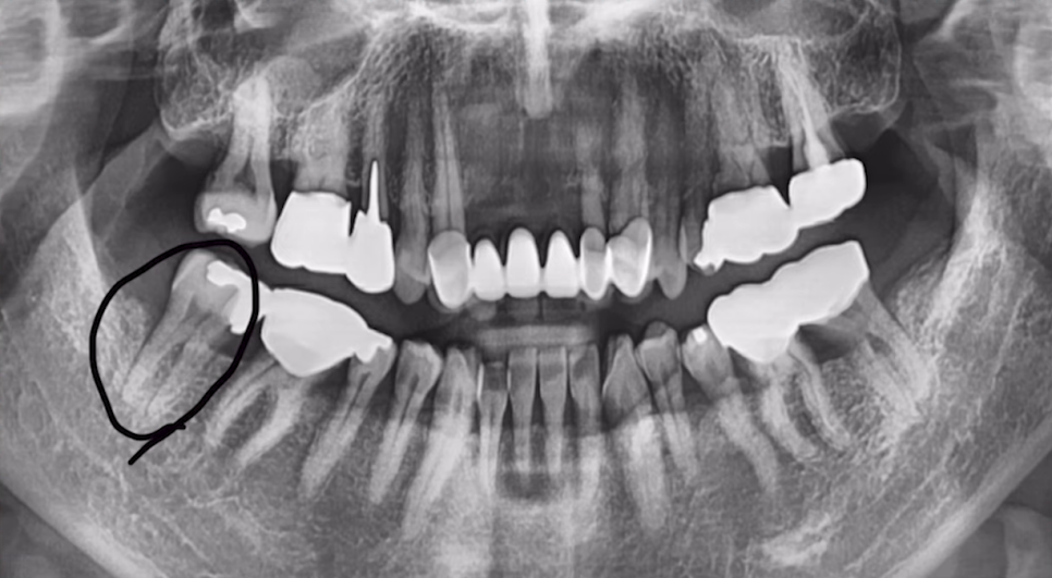 임플란트수술? 발치 즉시 vs 발치 후 임플란트 종류 따져보기 관련 이미지 3