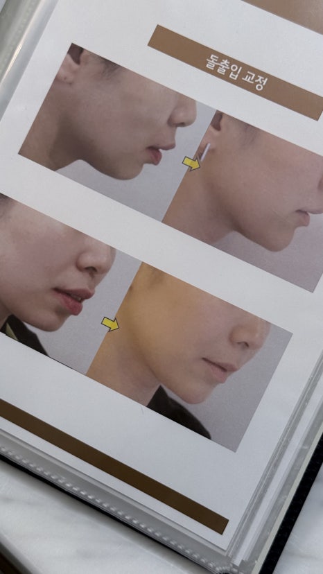 인비절라인 교정으로 몰래 예뻐지기, 스마일디치과 18년 노하우 관련 이미지 6