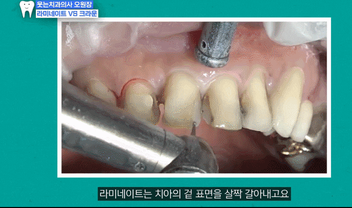 토끼앞니, 수지라미네이트처럼 하려다 평생 후회하는 이유 관련 이미지 3