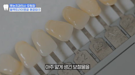 Front Tooth Laminate? Front Tooth Partial Orthodontics? How to Choose Without Regret image 10