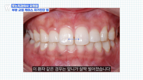 치아교정 앞니부분교정 가능할까? <전문의 답변> 관련 이미지 3