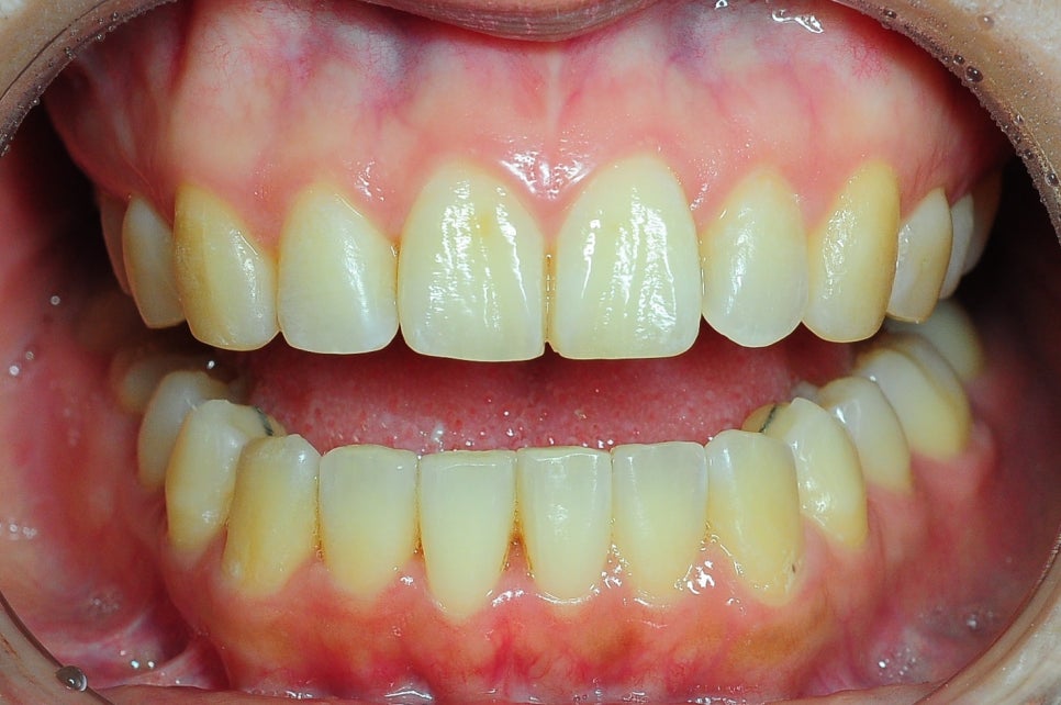 Does Invisalign Really Not Hurt? Do You Have to Have Teeth Extracted? image 10