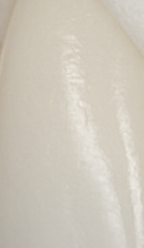 앞니 벌어짐 치료 전 반드시 체크해야 할 것들 정리 관련 이미지 27