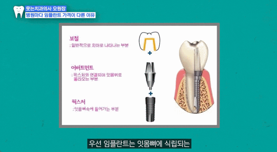 Implant Price: How Much Per Tooth? If You’ve Been Looking for a Cheap Place, Read This First image 2