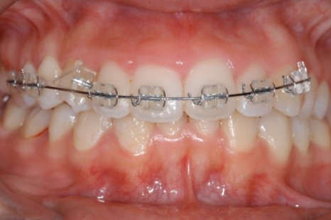 Key Points You Need to Know About Orthodontic Treatment Costs and Non-Extraction Orthodontics image 9