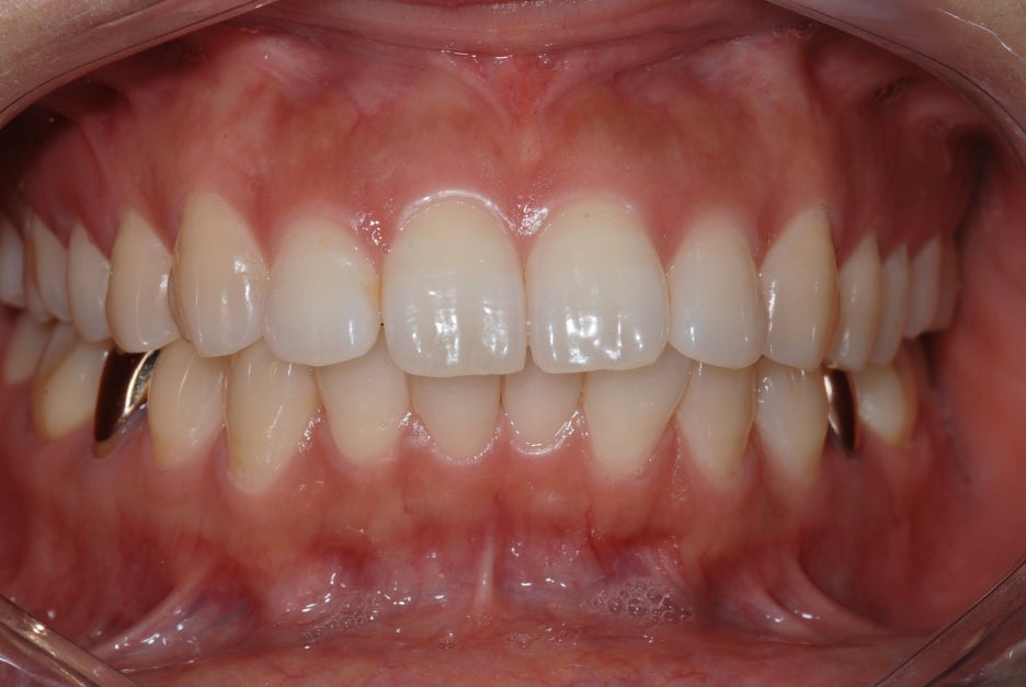 How to Save on Orthodontic Treatment Costs and Still Get Good Results image 4