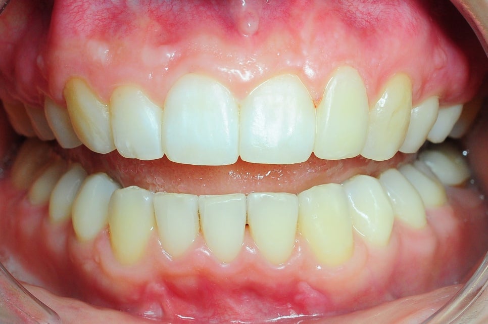 Key Points on the Principles, Duration, and Pain of Orthodontic Rubber Bands, as well as Clear Aligner Costs image 4