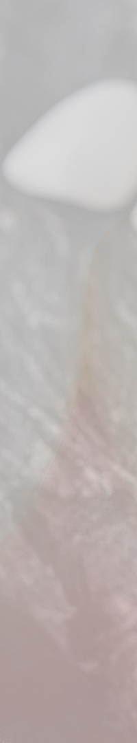 Looking Into Full Implant Placement Methods and Precautions image 21