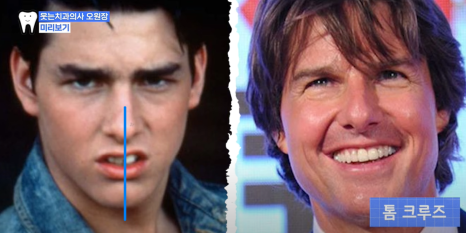 Protruding Mouth Correction Period? Can It Turn Out Like a Celebrity Before-and-After? image 2