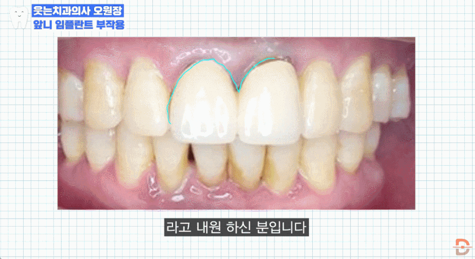 앞니임플란트치과 찾기 전 제발 이 글부터 읽어보세요 관련 이미지 18
