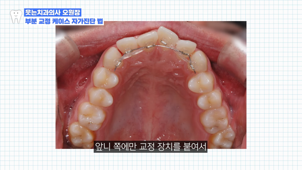 부분교정하고 이렇게 변했습니다 교정 전후 비교 관련 이미지 7